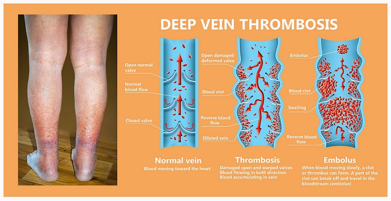 ¿Cómo prevenir y tratar la trombosis venosa?